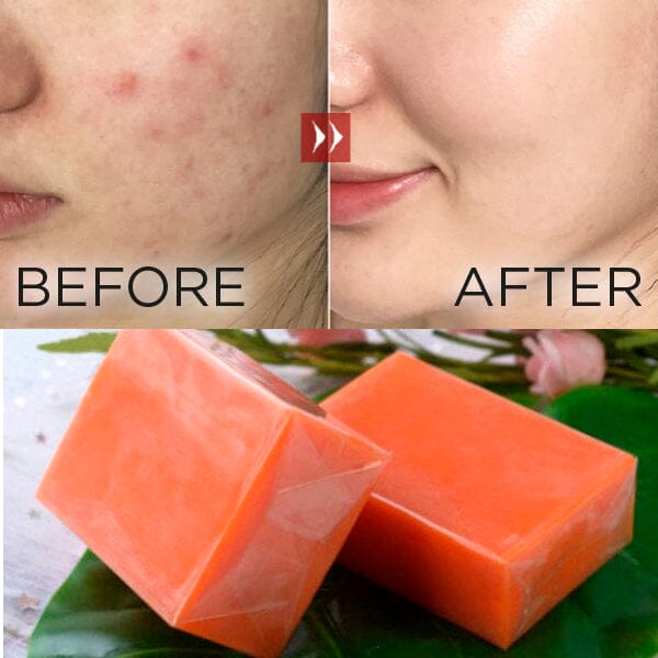 Kojic Acid Skin Brightening Soap (3-Pack)